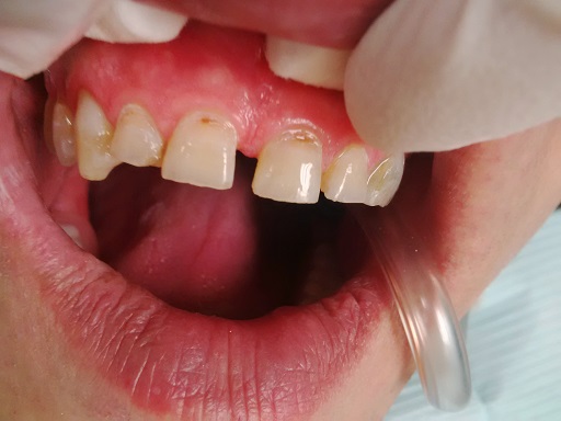 Cosmetic Dentistry - Case 1