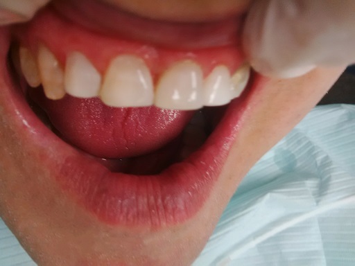 Cosmetic Dentistry - Case 1