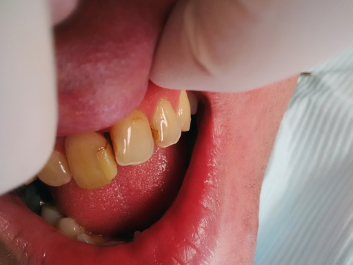 Cosmetic Dentistry - Case 2