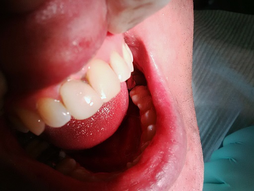 Cosmetic Dentistry - Case 2