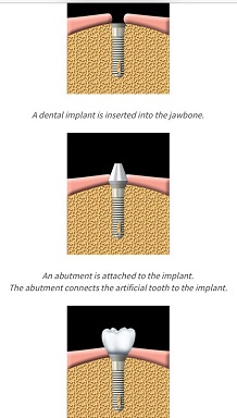 Implants