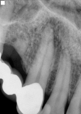 Root Canal - Before