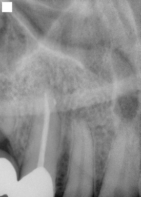 Root Canal - After